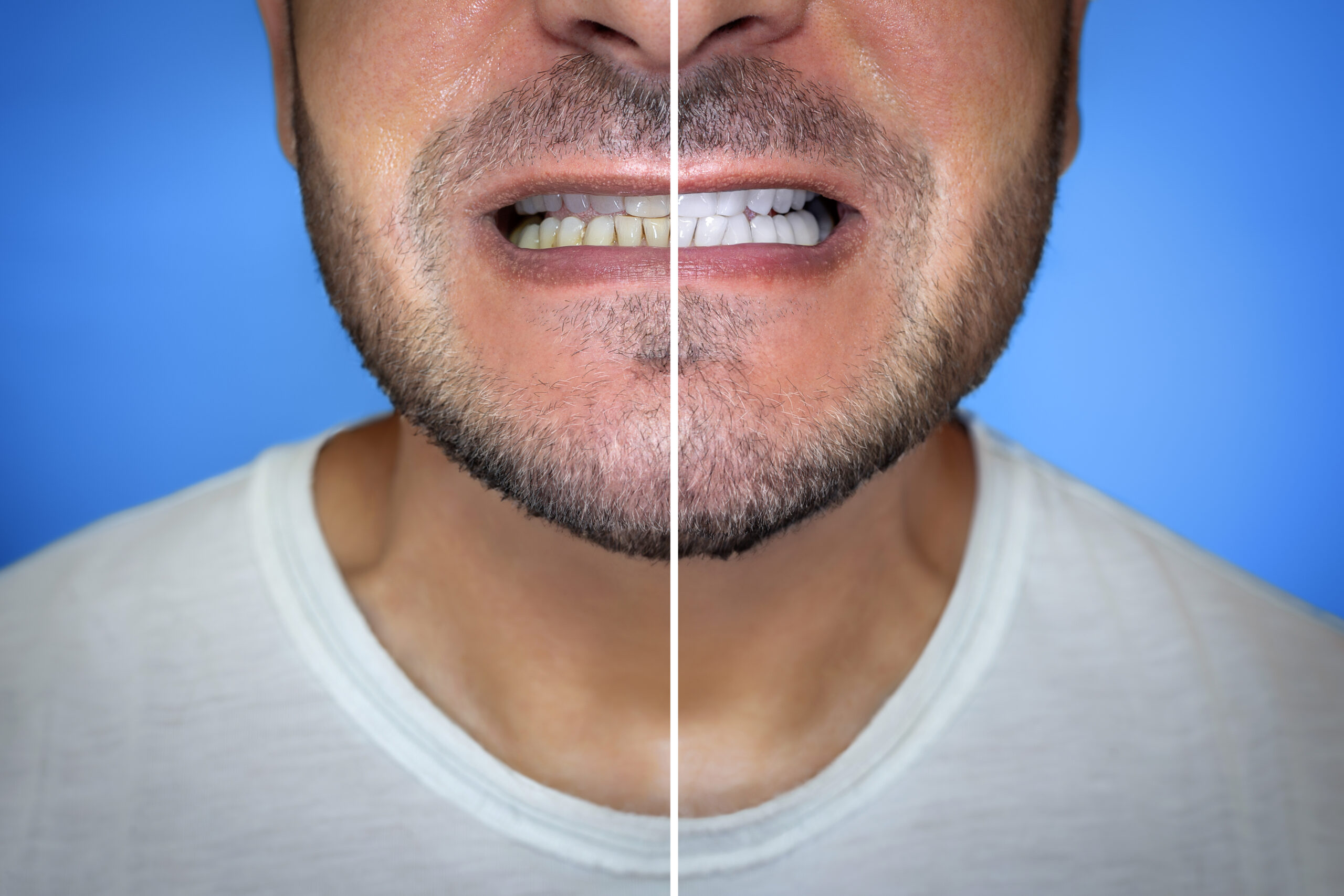 Clareamento Dental: Tudo o Que Você Precisa Saber Antes de Fazer