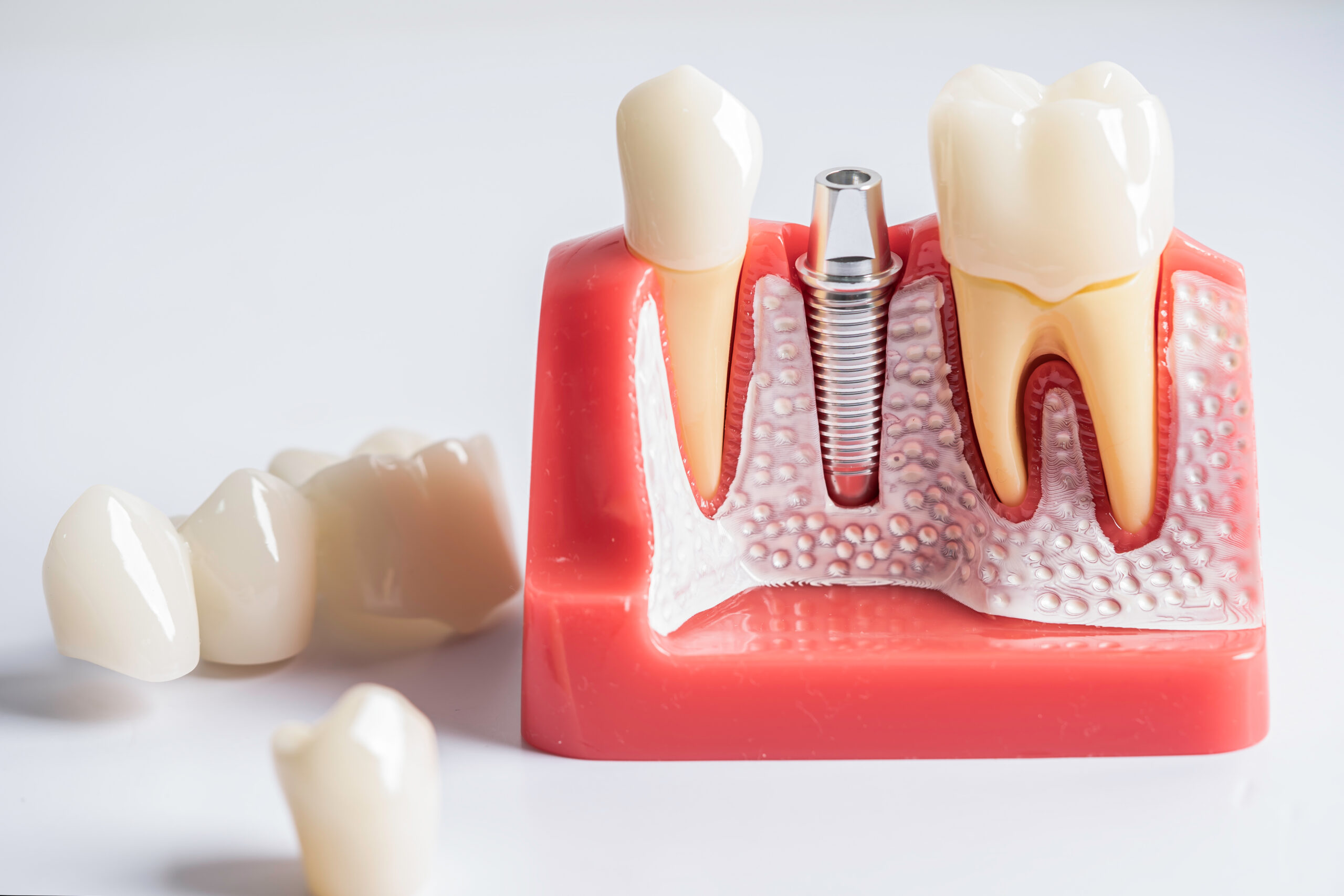 Implantes Dentários: A Solução Definitiva para um Sorriso Completo